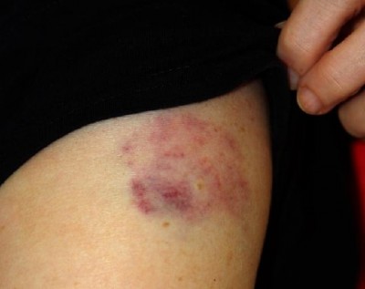 REd Right Arm